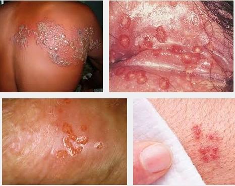 cara menyembuhkan penyakit herpes