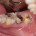 Nhổ răng sâu bị vỡ lớn có nguy hiểm không?