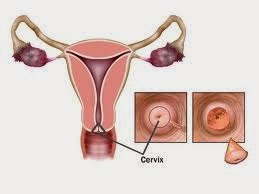 Ciri-ciri,Gejala,Penyebab Penyakik Kanker Rahim Dan Obat Alami