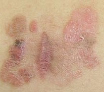 Bowen's Disease Pictures2