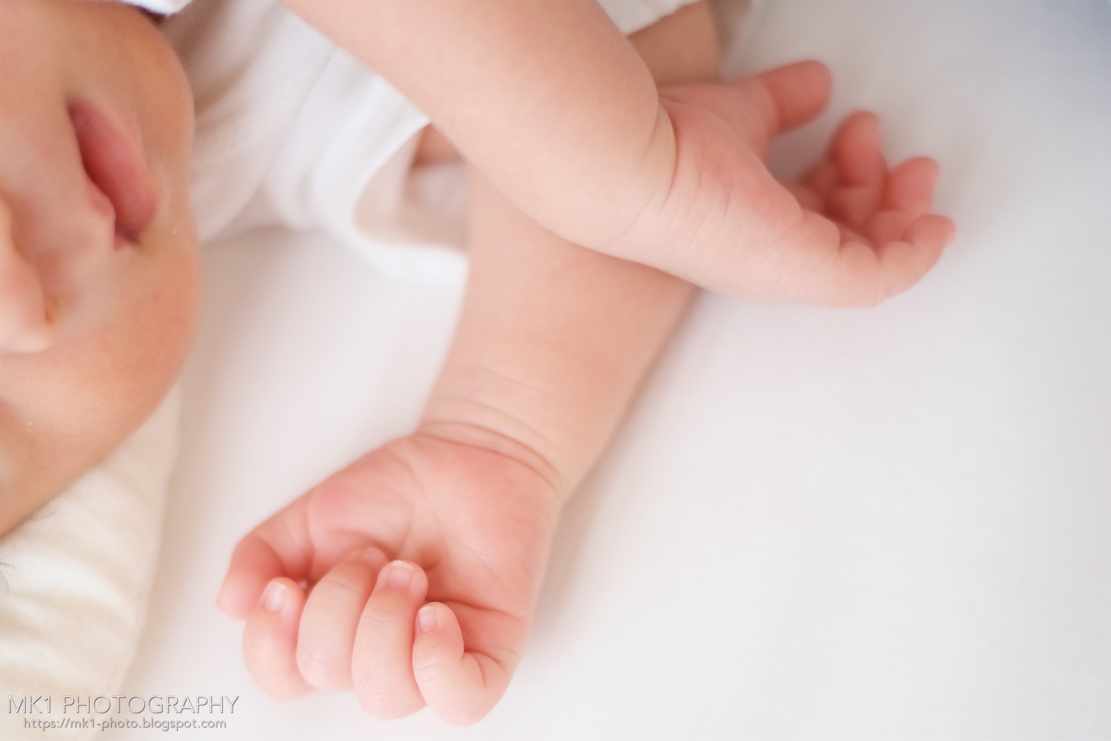 新生児黄疸と光線治療について