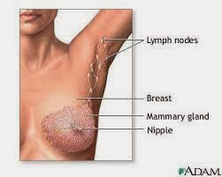 Breast cancer articles/Breast Cancer Information.Breast cancer usually happens when certain cells located in the breast start to grow out of control , taking over nearby tissue and spreading throughout the body . Large collections of this infected tissue are called " tumors " .