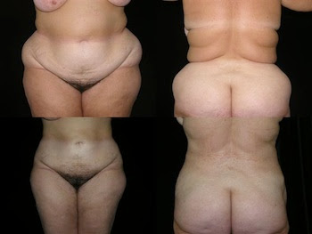 before and after picture of liposuction