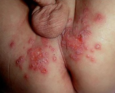 pengobatan herpes alami