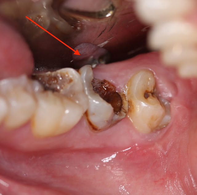 Răng khôn bị sâu nặng có nên nhổ bỏ hay không?