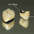Mất răng cửa có nên trồng răng sứ titan?