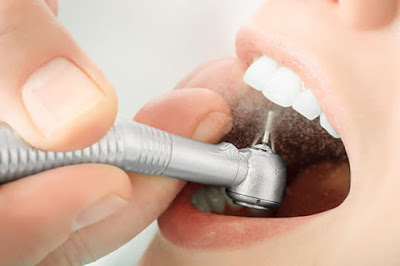 Mài răng nanh nhọn để làm gì?