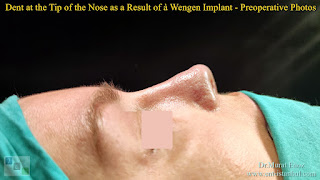 Breathe Implant à Wengen,4. revision nose job, Dent After Rhinoplasty, Complicated 4th Revision Rhinoplasty, Nasal contour irregularities, Postoperative dent issues, Revision rhinoplasty challenges, Rhinoplasty side effects, Nasal structural integrity,