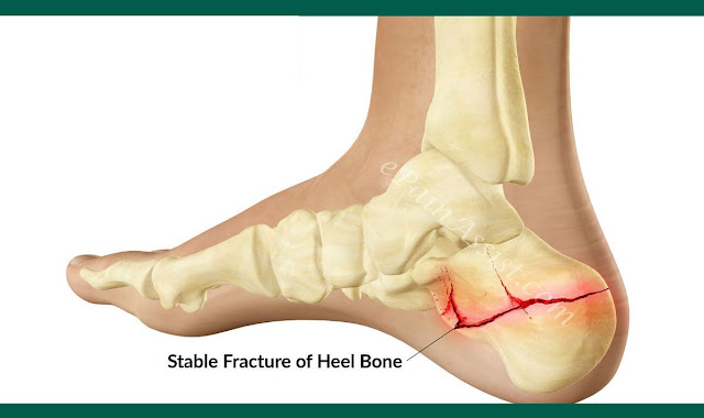 Stable Fracture Treatment | Stable Bone Fracture Surgery