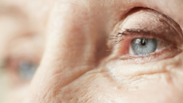 WHAT IS CATATACT? MAIN CAUSE ? TYPES OF CATARACT, SIGNS AND SYMPTOMS, HOW CAN YOU TREAT? EARLY SIGN OF CATARACT,  CATARACT VISION, DIAGNOSIS,  TREATMRNT