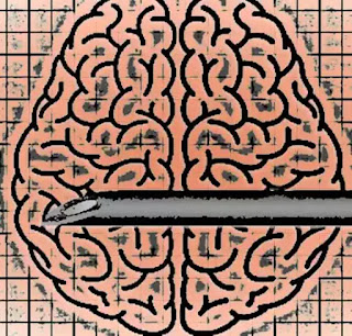 cum functioneaza implanturile cerebrale contra depresiei