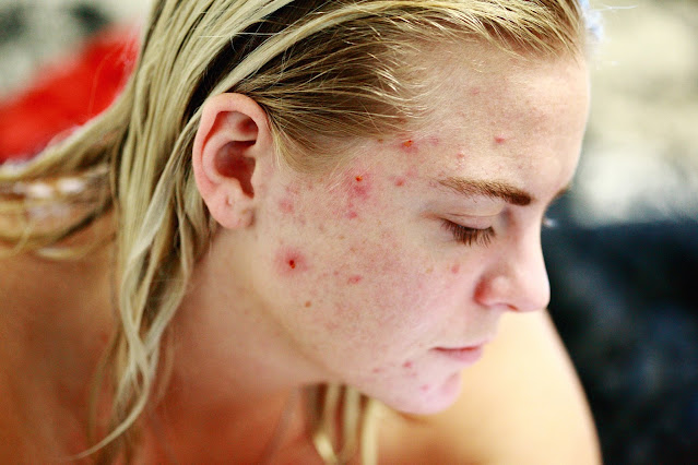 Red spots on the face and their treatment
