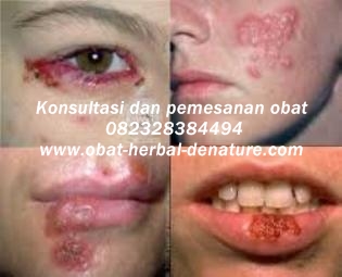 obat herpes kelamin,obat herpes zoster,obat cacar dompo,obat cacar air,obat herpes kemaluan,obat herpes tangan,obat herpes bibir,obat herpes badan