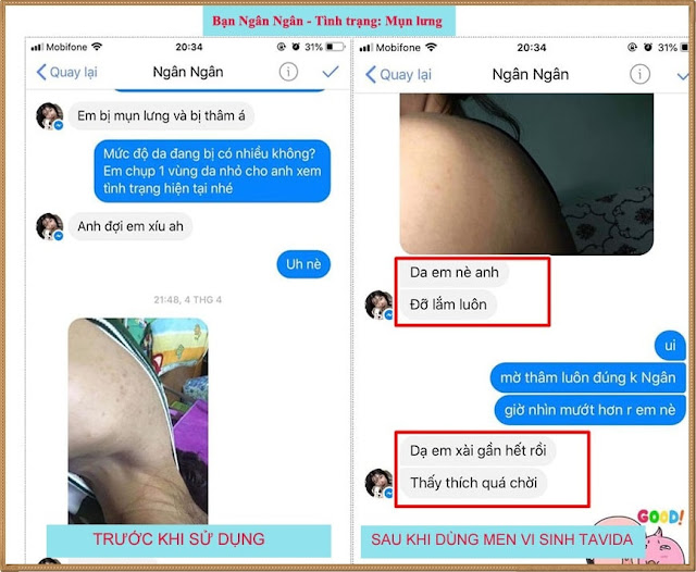 Tavida trị mụn lưng review