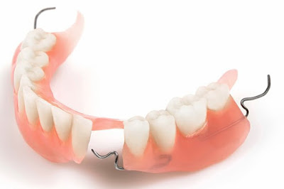 Trồng răng mất thời gian bao lâu với từng giải pháp? 1