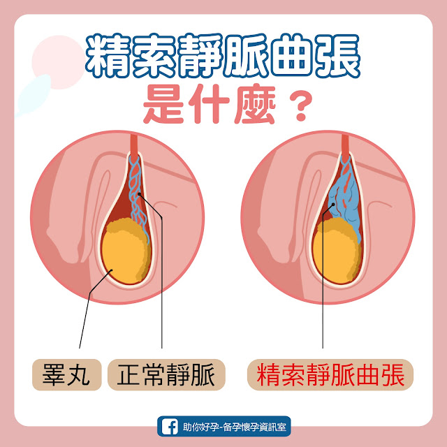 精索靜脈曲張是指男性陰囊內的靜脈產生不正常的腫脹