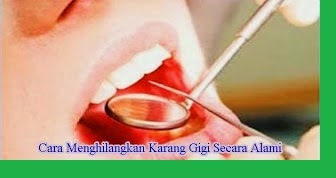 Cara Menghilangkan Karang Gigi