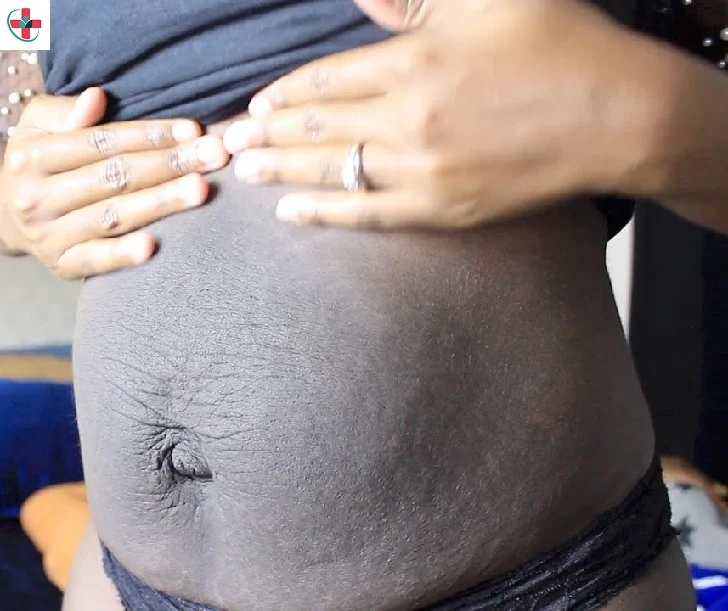 Belly Gone Dark After Pregnancy - My Omu Gwo Experience