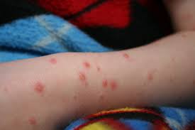 chickenpox, chickenpox vaccine, chickenpox symptoms, can you get shingles if you never had chickenpox, when did the chickenpox vaccine come out, what do chickenpox look like, chickenpox vaccine age, can you get shingles if you had chickenpox, chickenpox in adults, monkeypox vs chickenpox, smallpox vs chickenpox, how does chickenpox spread, what causes chickenpox, chickenpox in spanish, how is chickenpox spread, chickenpox and shingles, is there a vaccine for chickenpox, chickenpox vaccine history, shingles vs chickenpox, chickenpox treatments, signs of chickenpox, how do you get chickenpox, how long is chickenpox contagious, adult chickenpox, chickenpox vaccine for adults, shingles and chickenpox, is chickenpox herpes, pictures of chickenpox, can i get shingles if i never had chickenpox, treatment for chickenpox, how long does chickenpox last, when was the chickenpox vaccine created, when do kids get chickenpox vaccine, chickenpox treatment, how does chickenpox start, chickenpox vs shingles, is chickenpox still around, chickenpox smallpox, symptoms of chickenpox, chickenpox vs hand foot mouth, chickenpox vaccine efficacy, how long did it take to develop the chickenpox vaccine, chickenpox shingles, can you get shingles if you had the chickenpox vaccine, dangers of chickenpox vaccine, is chickenpox airborne, is there a chickenpox vaccine, chickenpox transmission, efficacy of chickenpox vaccine, chickenpox after vaccine, how contagious is chickenpox, chickenpox vaccine schedule, chickenpox airborne, chickenpox in adults second time, chickenpox vs smallpox, symptoms of chickenpox in adults, does the chickenpox vaccine prevent shingles, can you die from chickenpox, images of chickenpox, can you get chickenpox twice, when do babies get chickenpox vaccine, can chickenpox kill you, when was the chickenpox vaccine invented, chickenpox vaccine side effects how long after, hives vs chickenpox, how long does the chickenpox vaccine last, chickenpox vs hives, chickenpox in adults pictures, can you get shingles if you ve had chickenpox, cdc chickenpox, how do you catch chickenpox, what is chickenpox, chickenpox vaccine side effects cdc, where did chickenpox come from, chickenpox symptoms in adults, is one dose of chickenpox vaccine enough, does chickenpox vaccine prevent shingles, early signs of chickenpox, how do chickenpox start, chickenpox in mouth, rash after chickenpox vaccine picture, treatment of chickenpox, mild case of chickenpox, chickenpox vaccine side effects, can you get chickenpox from shingles, where do chickenpox start, beginning of chickenpox, is chickenpox deadly, show me a picture of chickenpox, chickenpox scars, chickenpox vaccine effectiveness, breakthrough chickenpox, what chickenpox look like, delta variant chickenpox, chickenpox virus, how do chickenpox look, chickenpox rash, chickenpox vaccine scar, difference between smallpox and chickenpox, difference between chickenpox and smallpox,