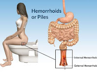 Cara Mengobati Penyakit Wasir Atau Ambeien