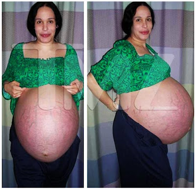 Octomom Before After