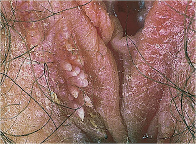 Genital warts of labia majora and perineum, with features of both   condylomata acuminata and keratotic warts