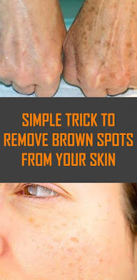 Simple Trick to Remove Brown Spots from Your Skin