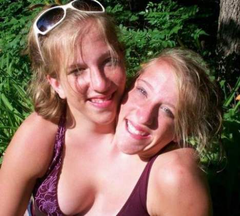 conjoined twins abby and brittany. they are conjoined twins