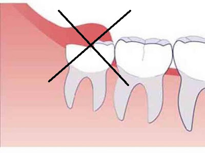 Điều trị viêm lợi trùm răng khôn như thế nào thích hợp?