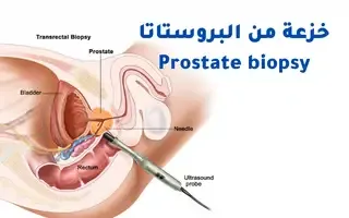 الخزعة والشفاء من سرطان البروستاتا prostate cancer