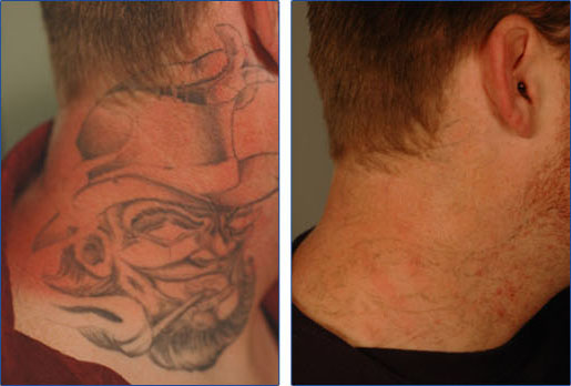Laser Tattoo Removal in Vascular Regions | Tattoo Removal ...