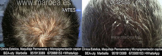 Micropigmentación capilar Granada CLÍNICA ESTÉTICA MARBELLA: Te ofrecemos la alta calidad de  nuestra asistencia, con los mejores expertos en micropigmentación capilar y maquillaje permanente en Granada y Marbella