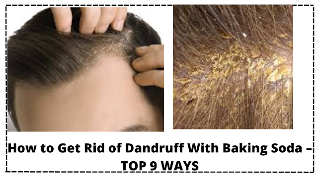 How to Get Rid of Dandruff With Baking Soda – TOP 9 WAYS