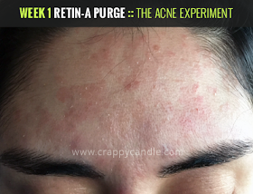 Week 1 Retin-A Purge :: The Acne Experiment