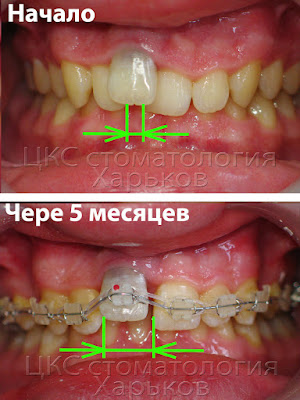 скрытые перемещения зубов