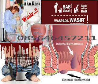 Obat Tradisional Radang Wasir (Hemoroid) Eksternal