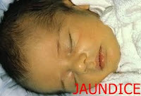 नवजात शिशु में जॉन्डिस (पीलिया) ,JOUNDICE NEWBORN BOBY