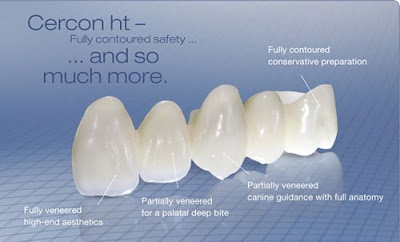 Những ưu điểm của răng sứ Cercon 
