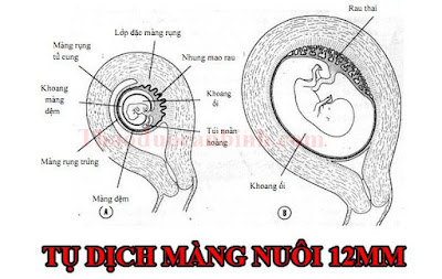 một trường hợp của tụ dịch màng nuôi