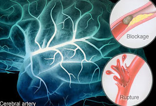 Cara Pengobatan Alami Stroke, Cara Pengobatan Alami Stroke, Penyakit Heat Stroke Adalah, Obat Herbal Untuk Sakit Stroke Ringan, Mengobati Lumpuh Karena Stroke, Mengobati Stroke Dengan Akupunktur, Terapi Pengobatan Stroke Hemoragik, Obat Tradisional Untuk Stroke Ringan, Obat Obatan Tradisional Untuk Penyakit Stroke, Penyakit Stroke Powerpoint, Tips Mengobati Gejala Stroke, Video Pengobatan Stroke, Obat Stroke Termanjur, Terapi Untuk Penyakit Stroke Ringan, Jurnal Kesehatan Penyakit Stroke Pdf 