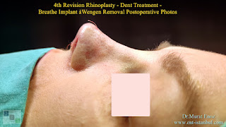 Breathe Implant à Wengen,4. revision nose job, Dent After Rhinoplasty, Complicated 4th Revision Rhinoplasty, Nasal contour irregularities, Postoperative dent issues, Revision rhinoplasty challenges, Rhinoplasty side effects, Nasal structural integrity,