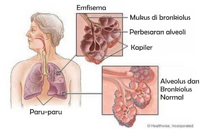 Penyebab, Gejala dan Pengobatan Emfisema