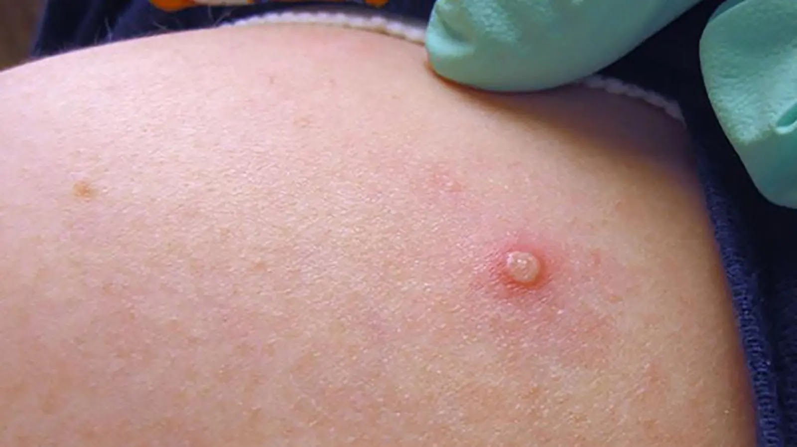 Monkeypox virus