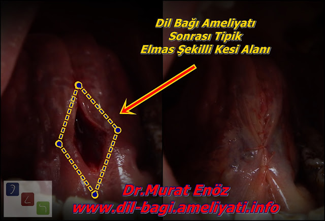 dil bagi uzatma dikişi - dil bağı kesilmesi - dil bağı ameliyatı