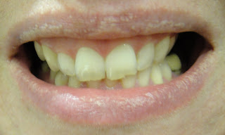 Zoom2! Tooth Whitening at The Welbeck Clinic