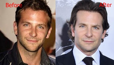 Rumor Bradley Cooper Melakukan Operasi Plastik