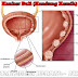 Cara Mengobati Kanker Buli (Kandung Kemih) Tanpa Operasi