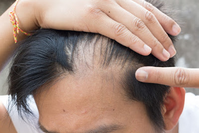 A man having hair loss