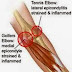 Επικονδυλίτιδα του αγκώνα - Tennis Elbow