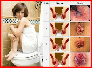 Cara Alami Menghilangkan Nyeri Wasir, Obat penyakit Ambeien Usus, Cara Alami Mengatasi penyakit Wasir Pasca Melahirkan, Obat Ambeien Natural, Obat buat penyakit Wasir Alami.Com, Harga Pengobatan Rumah Ambeien, Cara Menghilangkan Ambeien Secara Cepat, Obat Penyakit Ambeyen Menurut Resep Dokter, Ciri-Ciri Orang Penyakit Ambeien, Obat untuk penyakit Wasir Cara Alami, Obat untuk mengobati Wasir Aman Buat Ibu Menyusui, Forum Obat Ampuh Untuk Wasir, Obat penyakit Wasir Paling Cepat, Obat Ambeien Alami Dari Luar, Www.Obat Alami Wasir Atau Ambeien.Com, Obat penyakit Wasir Luar Salep, Cara Mengatasi Ambeien Atau Wasir Untuk Ibu Menyusui, Obat Wasir Atau Ambeien Alami Tanpa Operasi, Bagaimana Cara Mengobati Ambeien Atau Wasir Secara Alami, Obat buat penyakit Wasir Kulit Manggis, Www Cara mengobati penyakit Ambeien, Cara Menghilangkan Ambeyen Secara Cepat, Obat penyakit Wasir Cikarang, Obat Untuk Mengurangi Bengkak Pada Wasir Atau Ambeien, Obat Ambeien Atau Wasir Spesial Formula, Obat Herbal Untuk Ambeyen Ambeyen, Obat Wasir Pada Bayi, Pengobatan penyakit Ambeien Secara Alternatif, Mengobati Ambeien Atau Wasir Parah, Cara Mengobati Wasir Atau Ambeien Dengan Obat Alami